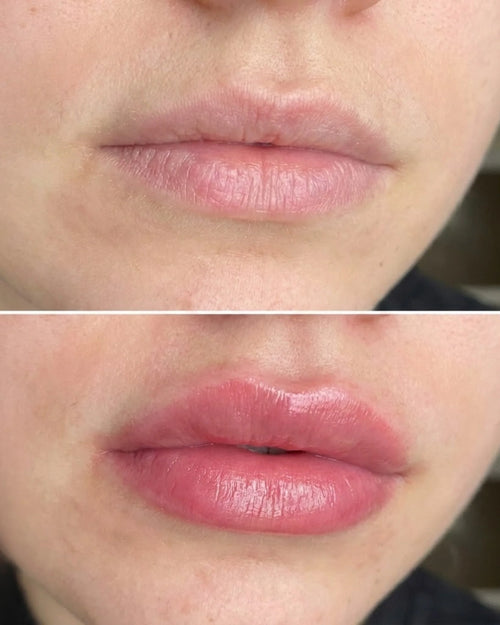 Extreme Lip Plumper