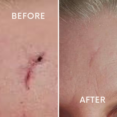 Silicone Scar Stick