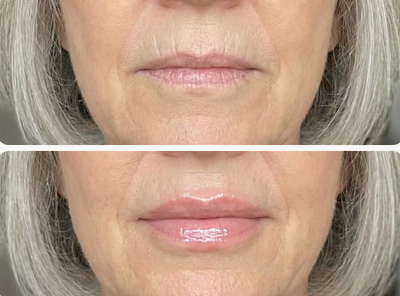 Extreme Lip Plumper