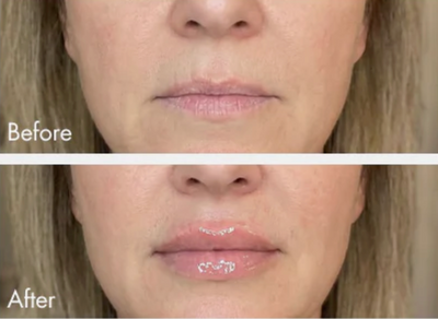 Extreme Lip Plumper