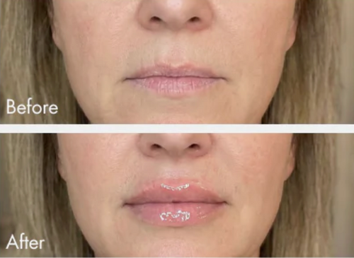 Extreme Lip Plumper