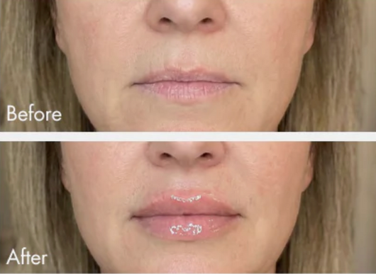 Extreme Lip Plumper